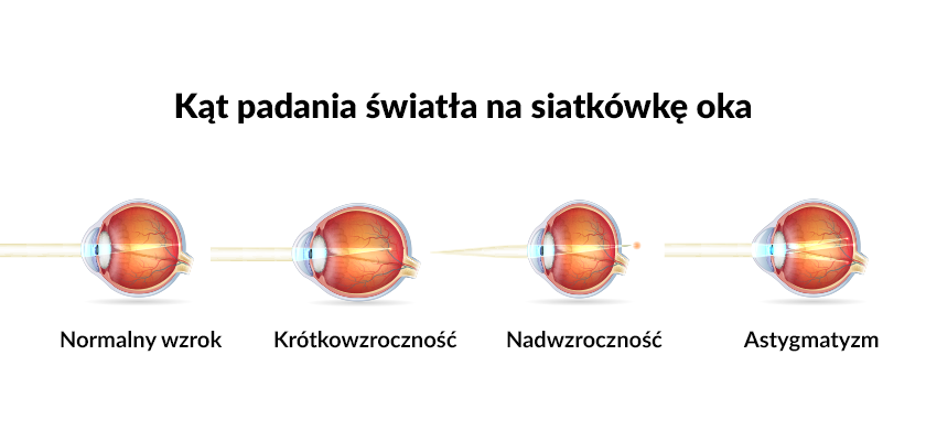 Astygmatyzm Jak Dobra Odpowiednie Soczewki Kontaktowe 